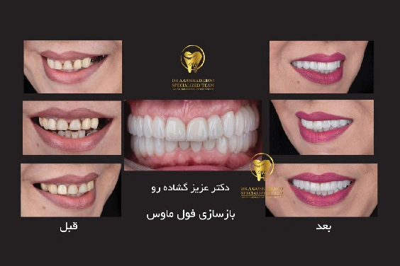 تفاوت لمینت سرامیکی و کامپوزیت دندان
